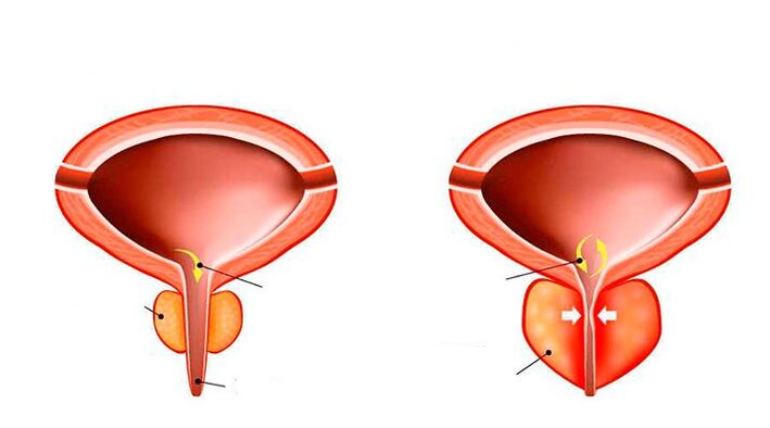 Normal and inflammatory prostate