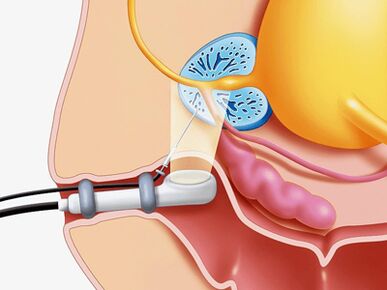 Postate gland Ponxial biopsy