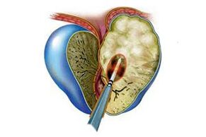 Manifestation of acute prostatitis